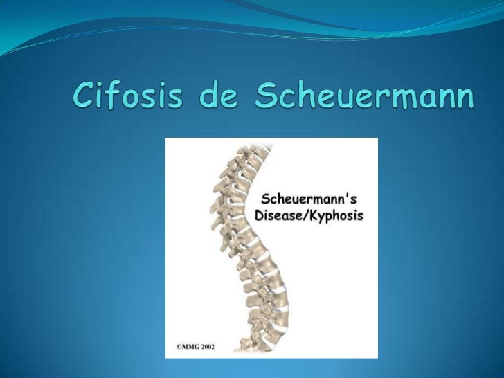 cifosis de scheuermann